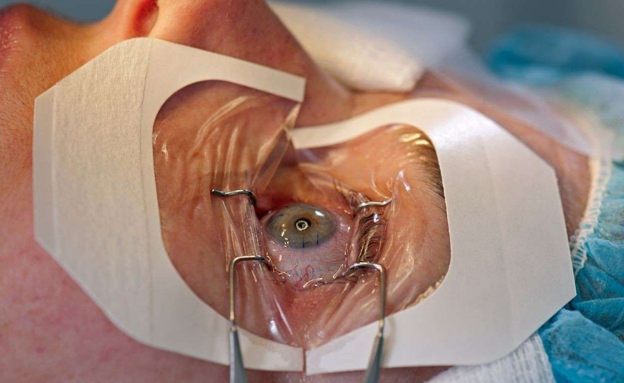 LASIK Surgery Procedure